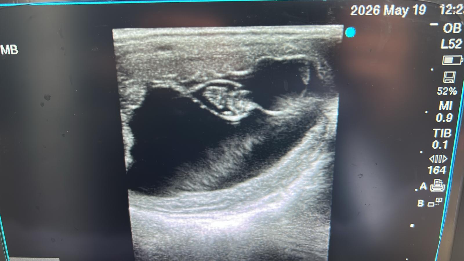 Ultrasound 2026-05-19